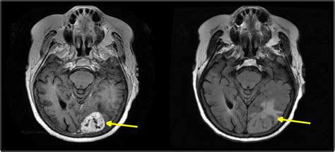 T1 post-contrast image (left) and T2 FLAIR image (right) after... | Download Scientific Diagram