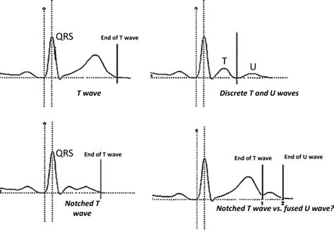 Measuring QT in presence of U wave | Download Scientific Diagram