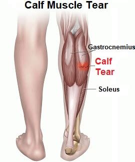 Calf Muscle Strain: Causes, Symptoms and Treatment - Knee Pain ...