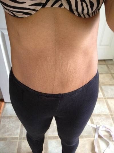 Tummy tuck before after pictures Houston top best plastic surgeons photos » Tummy Tuck: Prices ...