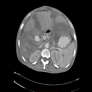 Lv Apical Aneurysm Vs Pseudoaneurysm | semashow.com