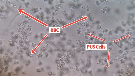 bacteria in urine sample