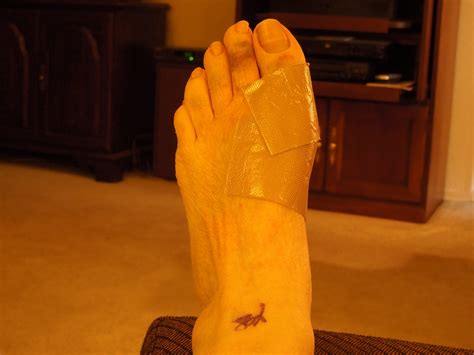 Foot Surgery | Barbara Radisavljevic | Flickr
