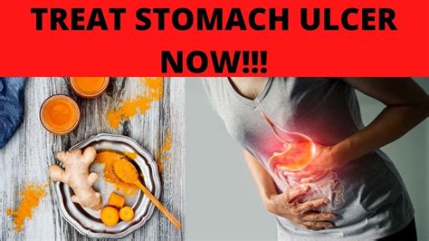 What Is Hte Medical Treatment For Stomach Ulcers