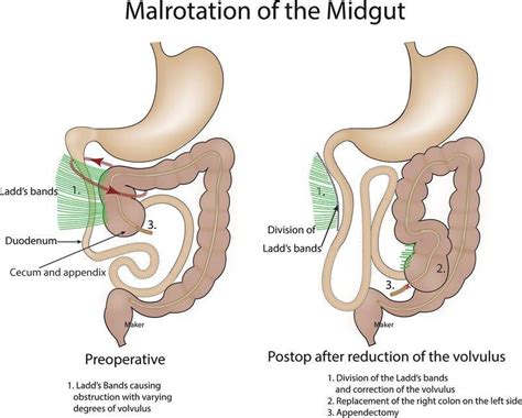 Ligament Of Treitz Malrotation