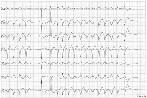 Sinus Ventricular Tachycardia