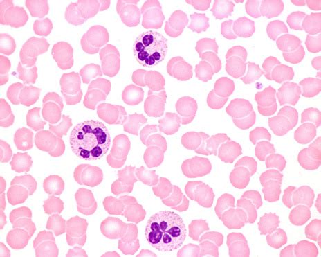 Human Blood Smear Neutrophil Hypersegmentation Stock Photo - Download Image Now - Biological ...