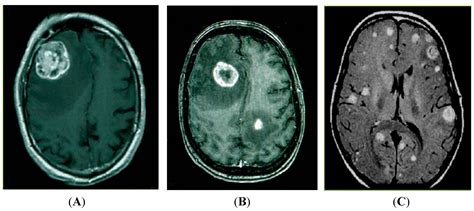 IJMS | Free Full-Text | MicroRNAs in Brain Metastases: Potential Role as Diagnostics and ...