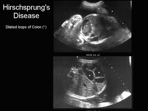 Hirschsprung And Down Syndrome - Captions Profile