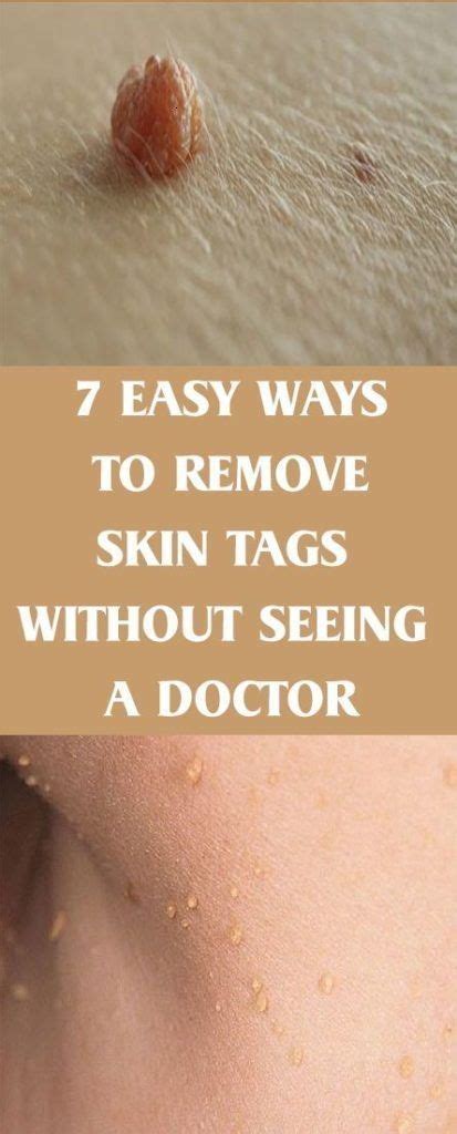 How to Remove Moles, Warts, Blackheads, Skin Tags, and Age Spots Completely Naturally! in 2020 ...