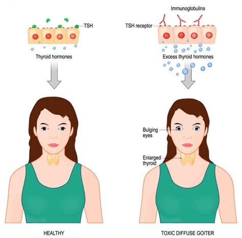 What is thyroid eye disease and can it be treated?: Lowcountry Eye Specialists : Ophthalmologists