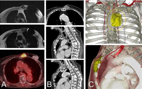 An 82-year-old woman with a malignant spindle cell sarcoma in the... | Download Scientific Diagram