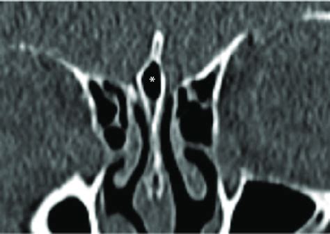 The crista galli (*) (pneumatised variant) sits anteriorly in the ...