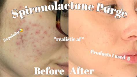 How to treat acne from spironolactone purge | Spironolactone before and ...