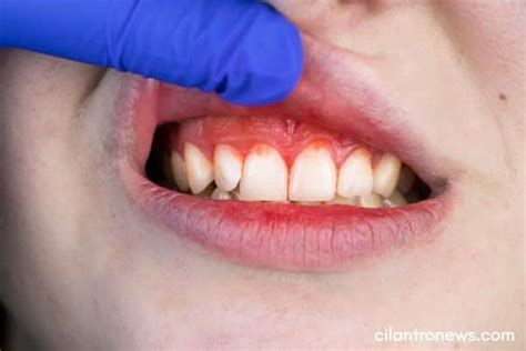 How To Cure Gum Disease Without A Dentist - Cilantro News