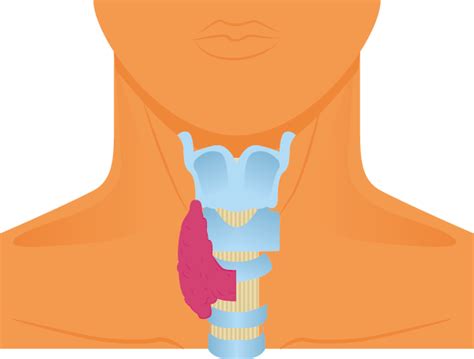 Thyroidectomy (Thyroid Surgery) - Total and Lobectomy | Saint John’s Cancer Institute - Santa ...