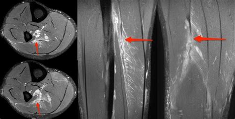 Case of the Week - Lateral Soleus Intramuscular Aponeurosis Tear - Imaging @ Olympic Park