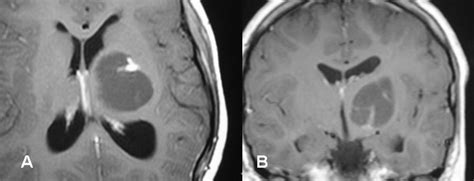 Stereotaxic gamma knife surgery in treatment of critically located pilocytic astrocytoma ...