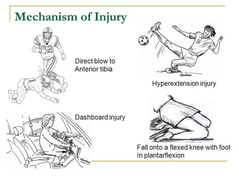 Posterior Cruciate Ligament Injury - Masnad Health Clinic