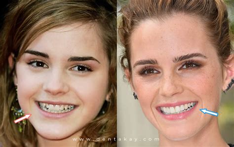 Emma Watson Before And After Braces