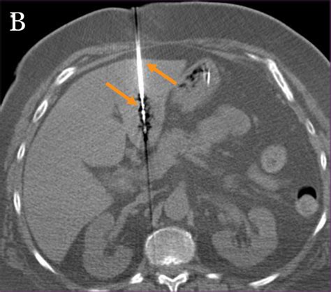 Figure A: Non-contrast CT demonstrating a 2.3 cm hypodense lesion in ...