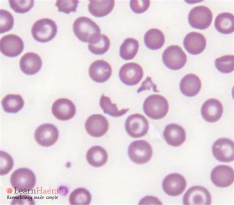 Schistocyte