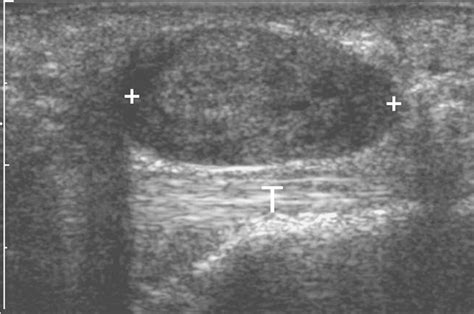 Giant Cell Tumor Of Tendon Sheath Ultrasound