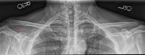 Acromioclavicular Joint Dislocation X Ray