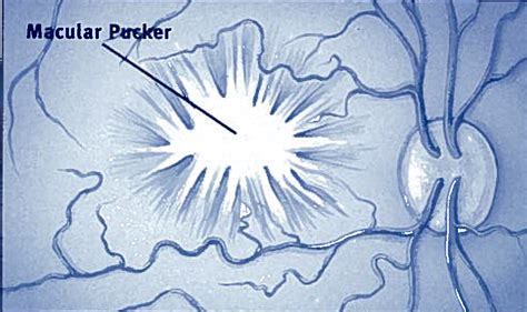 Macular Pucker | Retina Specialists | Eye Surgery | Retina Associates | Cameron Javid, MD