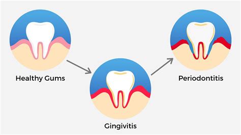 Periodontitis, Gum Disease and How to Treat it - Method Dental