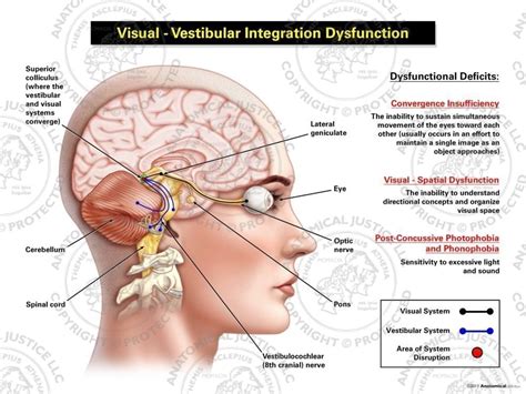 Female Right Visual - Vestibular Integration Dysfunction