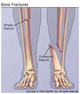 Compound Bone Fracture