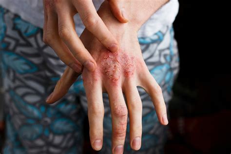 Natural Ways to Deal With Eczema On Hands - Dr. Ana-Maria Temple