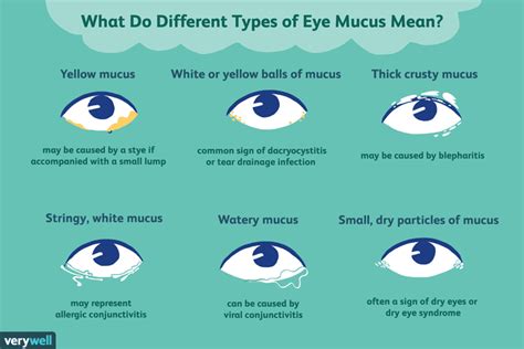 Types of Eye Mucus, Discharge, and Boogers