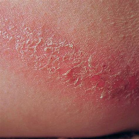 Redness often accompanied by tiny spots or bumps in areas of high friction.