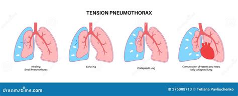 Tension Pneumothorax Poster Cartoon Vector | CartoonDealer.com #275372085