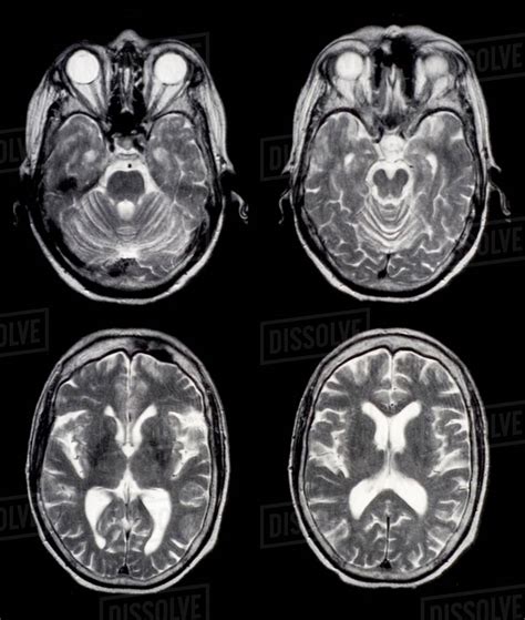 Mri Anatomy Brain Axial Image Brain Anatomy Anatomy Of Brain Brain | My ...