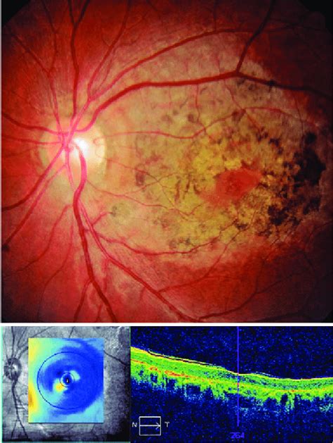 Case 1: Macular dystrophy. | Download Scientific Diagram