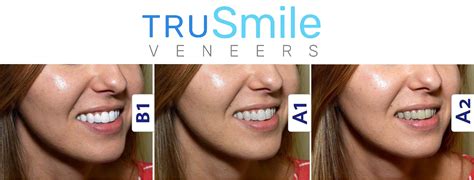 TruSmile Custom Made Veneers – TruSmile Veneers in 2020 | Veneers ...