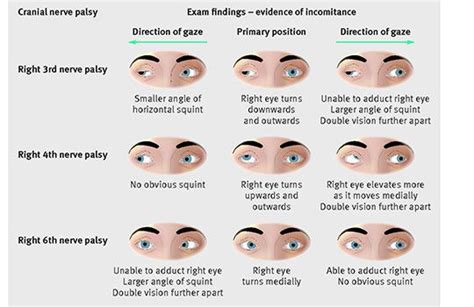 Figure to use in a consultation with a patient with double vision. The ...