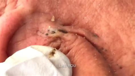 Blackhead on Ear! - YouTube