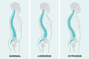 Kyphosis vs. Lordosis: What's the Difference? | The Healthy