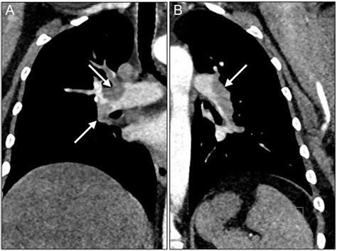 Pulmonary Embolism - Causes, Signs & Symptoms, Diagnosis, Treatment