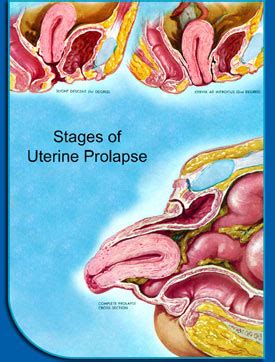 Pelvic Organ Prolapse | Atrium Health