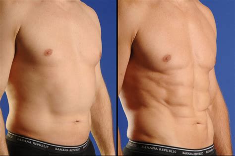 Smartlipo TriPlex abdomen - SHINO BAY Cosmetic Dermatology & Plastic Surgery Fort Lauderdale ...