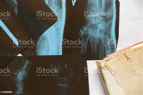 Xrays Of A Womans Hand With A Fracture Xray Health Care Stock Photo - Download Image Now - iStock