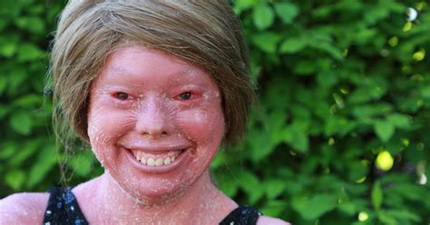 Harlequin Ichthyosis Survivor