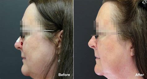 Reconstructive Surgery Photos | Princeton, NJ | Patient 9865