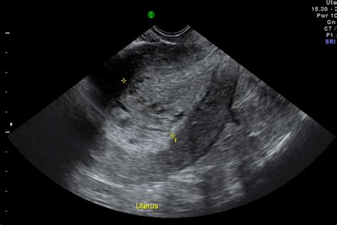 Chapter 12 – Cancer of the Endometrium – Melaka Fertility