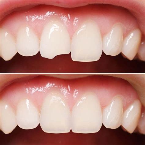 Here’s How You Can Fix Your Chipped Tooth with Cosmetic Dentistry at SmilePerfectors, Tysons ...